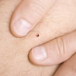 removing a tick from skin